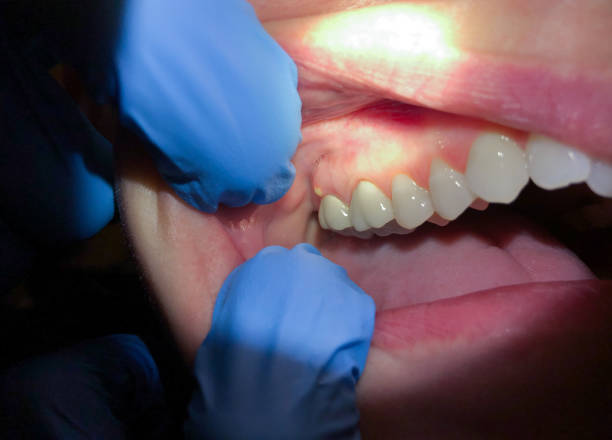 Best Emergency Wisdom Teeth Removal in Mikes, TX